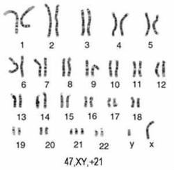 down syndrome karyotype